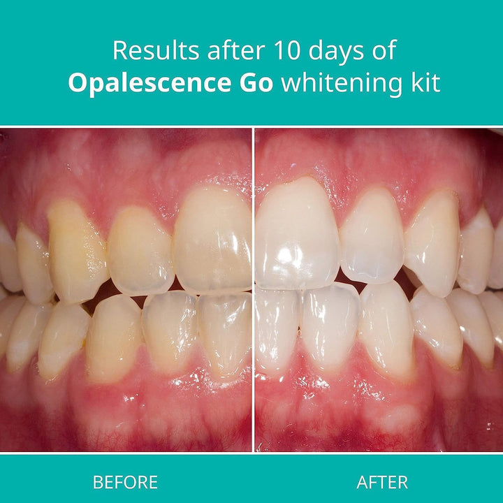 Opalescence Go! 15% Mint 20 Trays Teeth Whitening Trays – Professional Strength, Pre-Filled & Ready to Use
