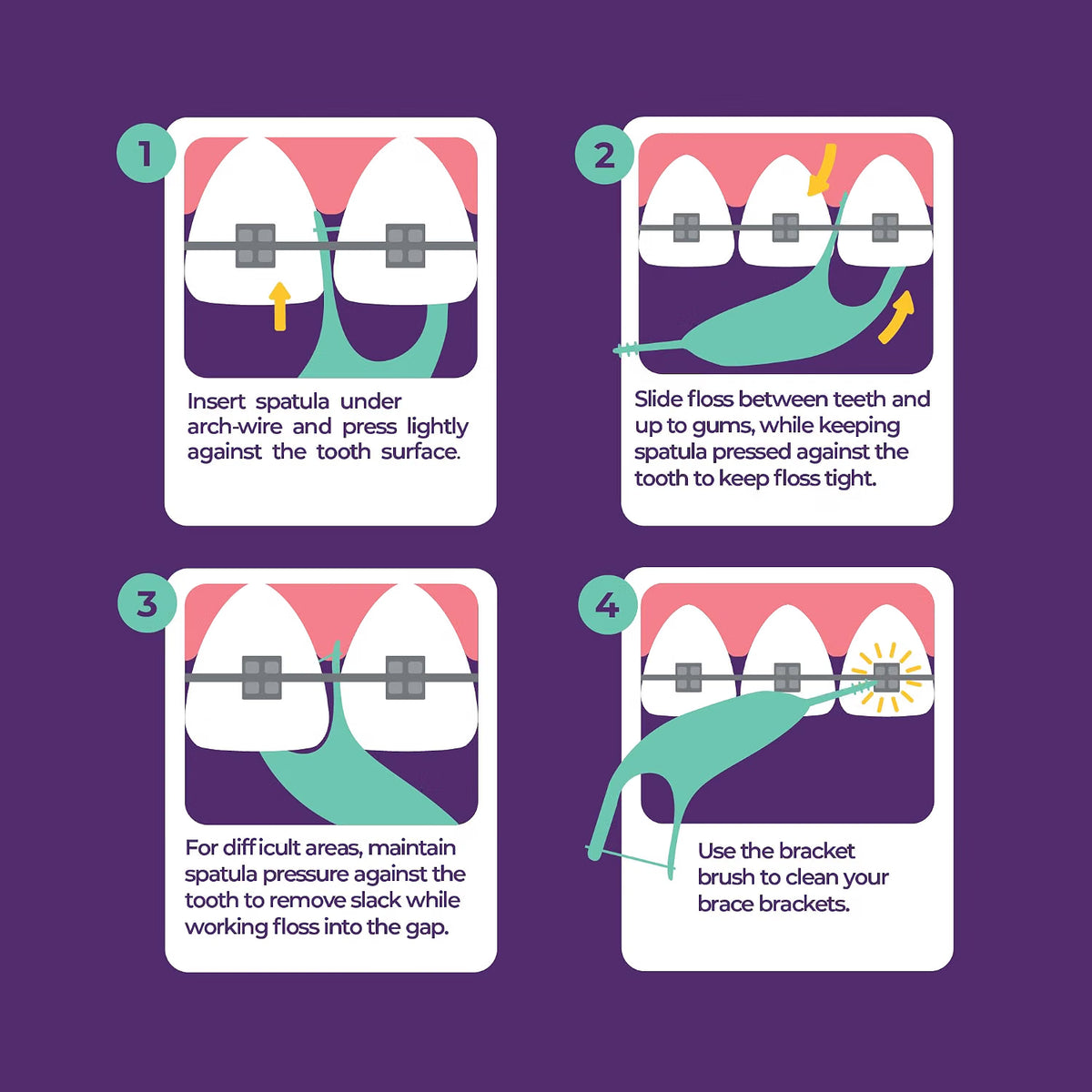 Four numbered steps showing the spatula going under the arch-wire and the floss worked to the gums