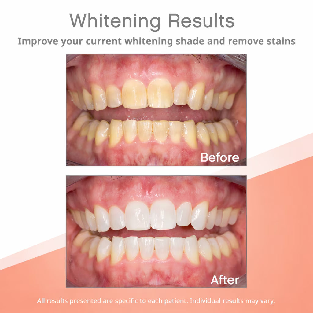Opalescence Go! 10% Melon 20 Trays Teeth Whitening Trays, Pre-Filled & Ready to Use