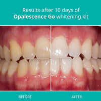 Opalescence Go! 15% Mint 20 Trays Teeth Whitening Trays – Professional Strength, Pre-Filled & Ready to Use
